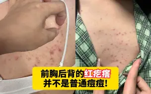 下载视频: 【科普】前胸后背的红疙瘩有2种类型，你瞎挤，小心长满后背！