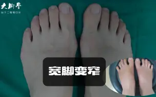 Download Video: 宽脚变窄，同时解决大脚骨和小脚骨，大脚骨整形专家帮她实现了这个愿望