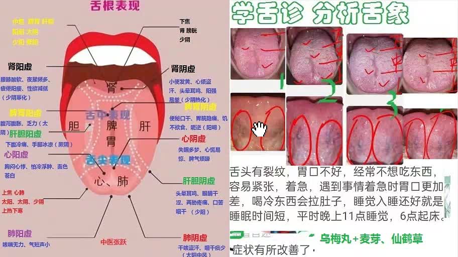 地图舌裂纹舌到底全是阴虚问题吗 哪个好恢复些哔哩哔哩bilibili