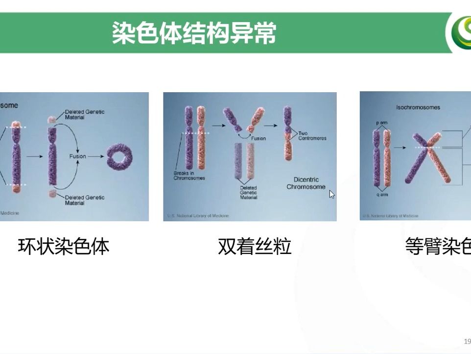 染色体变异与遗传病罗伯逊易位:21三体综合征哔哩哔哩bilibili