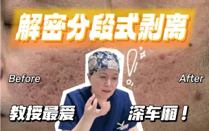 Descargar video: 深车厢坑好治！联合分段式剥离很关键！