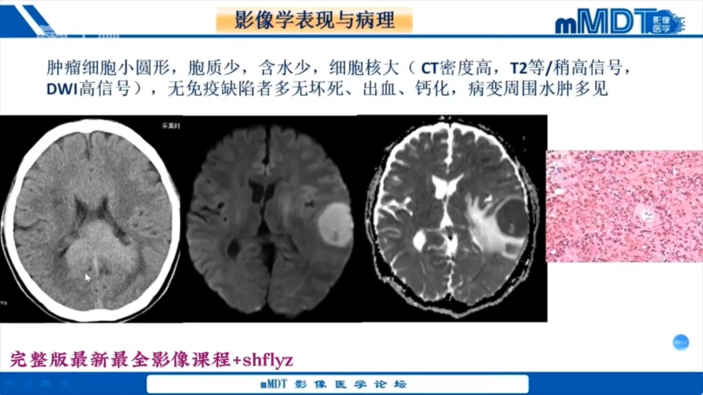 mMDT中枢神经系统肿瘤培训班22讲06:中枢神经系统淋巴瘤影像诊断郑学军哔哩哔哩bilibili