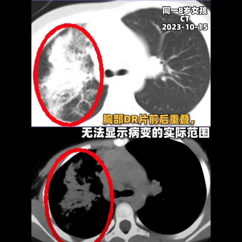 胸片上:肺炎也有带状的,不要认为都是斑片状的.因为胸片是重叠的哔哩哔哩bilibili