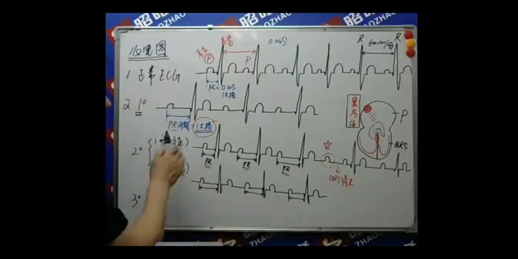 心电图②哔哩哔哩bilibili