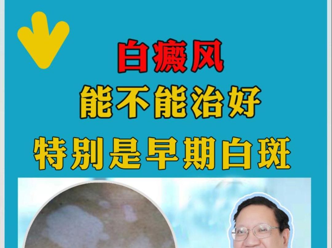 得了白癜风能不能治好?特别是早期白斑应该怎么治?广东哪家白癜风医院好哔哩哔哩bilibili