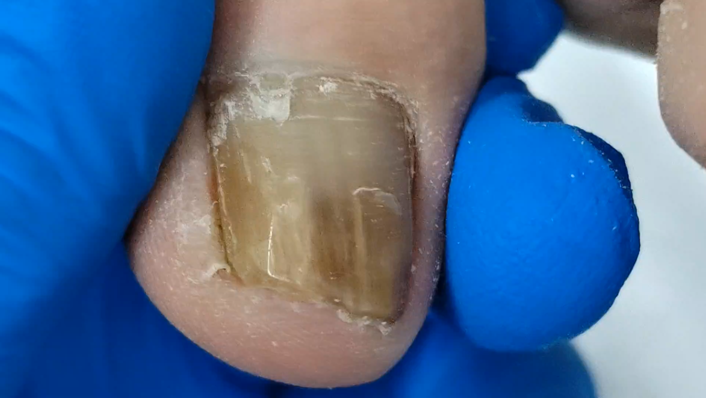 又厚又硬的灰指甲