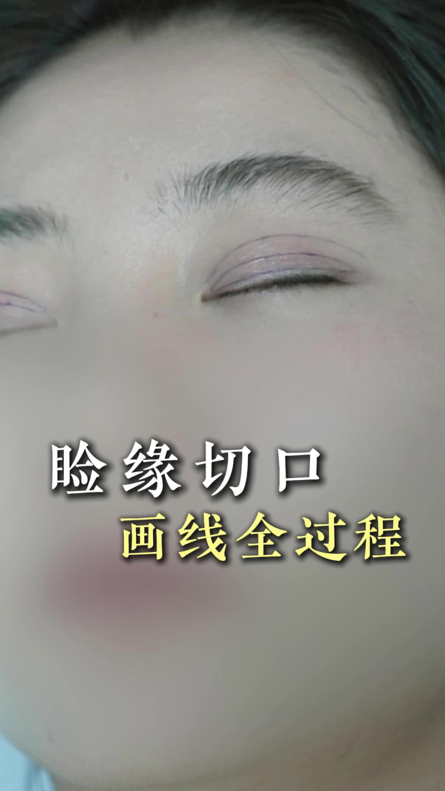 睑缘切口画线全过程