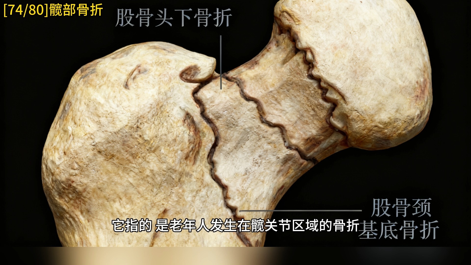 [74]髋关节骨折：“人生最后一次骨折”