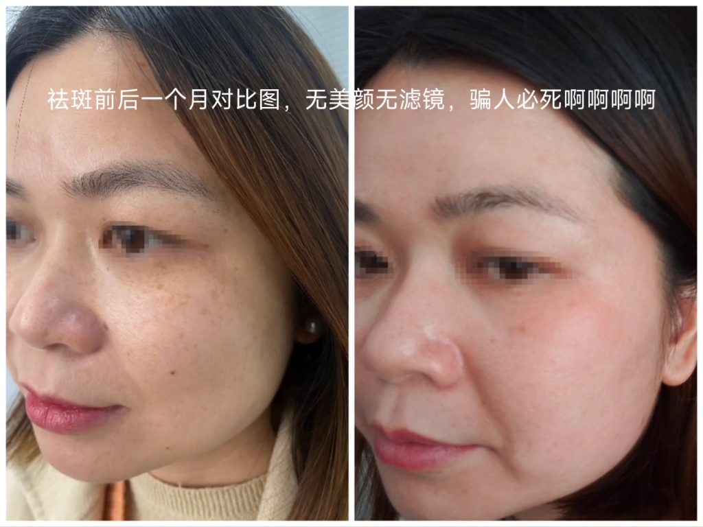 左边图祛斑前,有雀斑和真皮斑的混合斑;右边图祛斑后,雀斑已祛除只剩