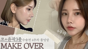 整形vlog 隆鼻 轮廓手术 颧骨 下颌骨 改善鼻头下垂 矫正不对称 哔哩哔哩 つロ干杯 Bilibili