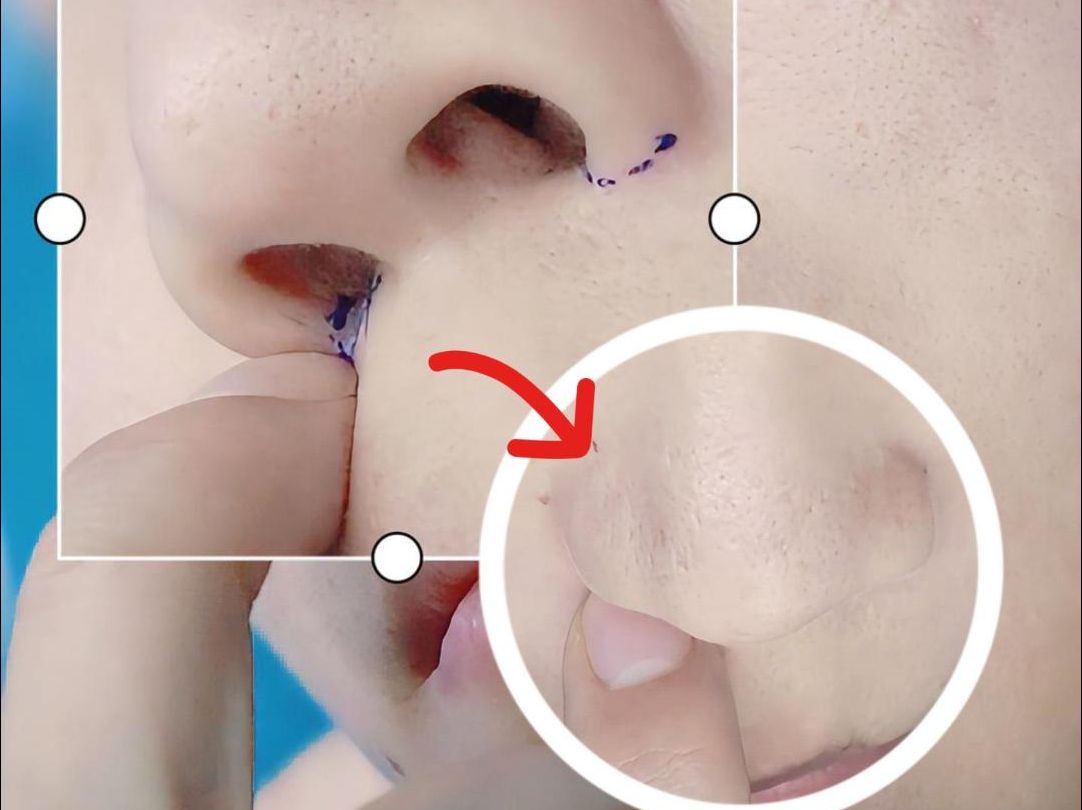 缩鼻翼现场模拟