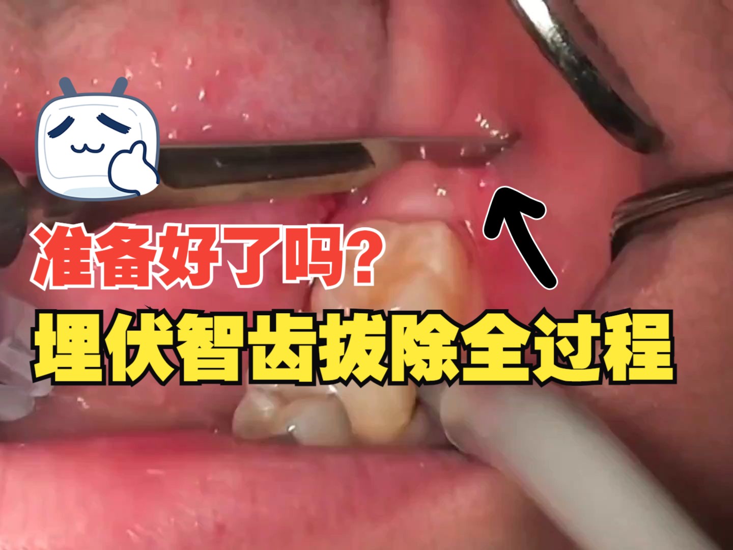 [图]埋伏智齿拔除全过程，没拔过的不要看，拔了的喜欢看