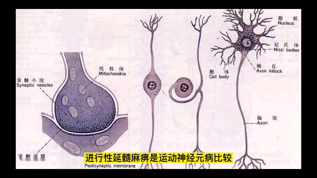 进行性延髓麻痹是运动神经元病罕见的一种疾病