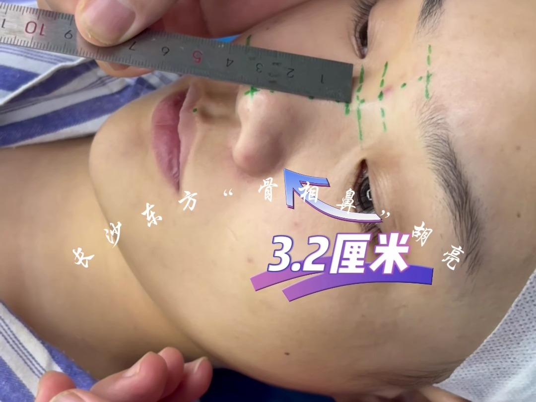 鼻子太短,东方骨相鼻如何从3.2cm延长到4.5cm
