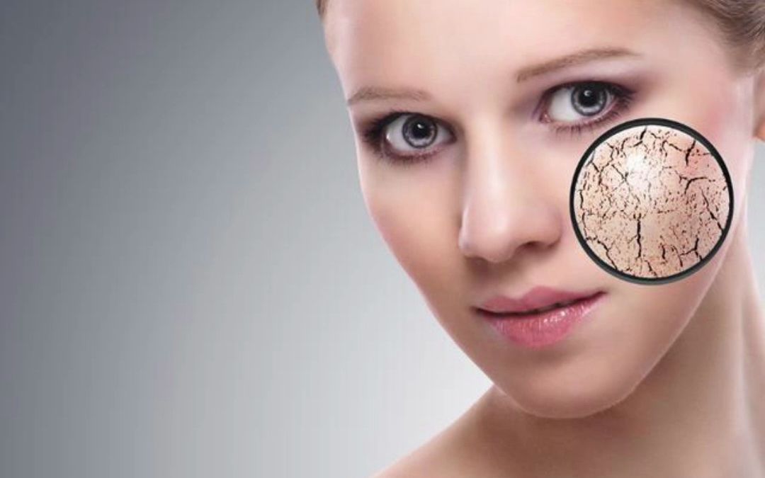 春天脸上皮肤干燥起皮怎么办?