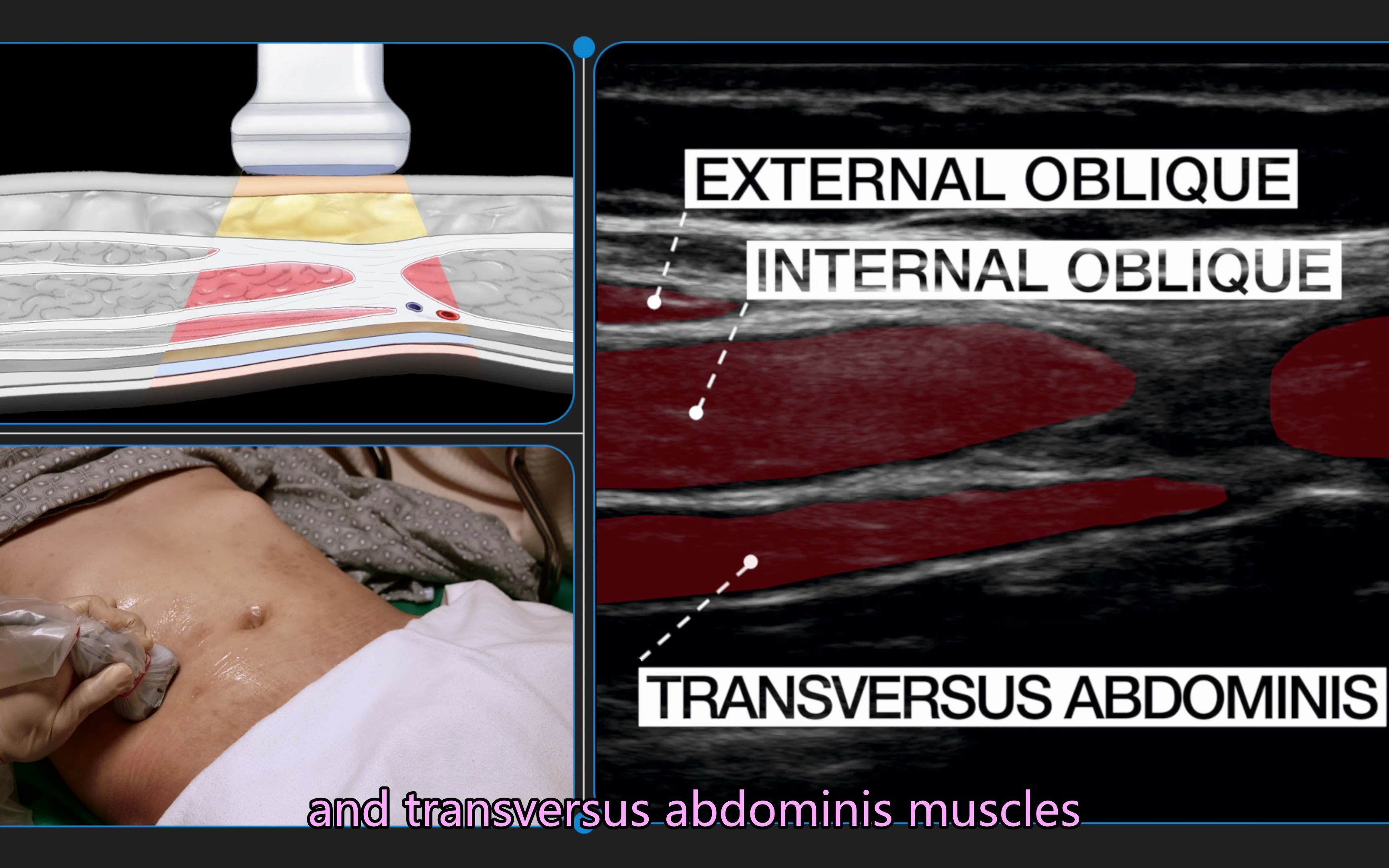 如何正确识别腹横肌平面 (TAP) 阻滞的解剖结构(英文字幕)哔哩哔哩bilibili