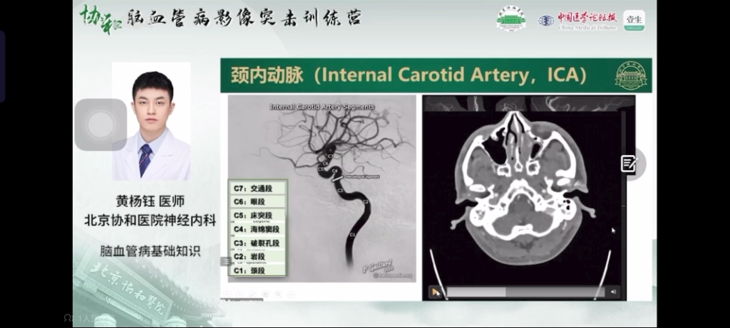 经典系列0002CTA源图像颈内动脉分段及走形(颈总——颈内——大脑前和大脑中)哔哩哔哩bilibili