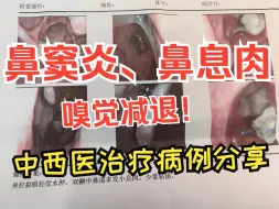 Download Video: 鼻炎、鼻窦炎、鼻息肉，成功控制的医案分享