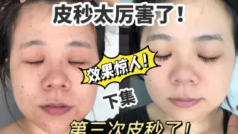 第三次皮秒啦！黑科技真的很厉害！（下集）