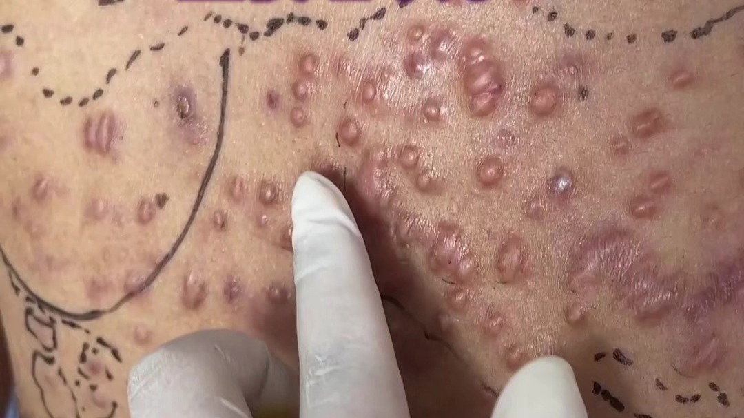 胸前多发性疤痕疙瘩:这些知识你需要知道!