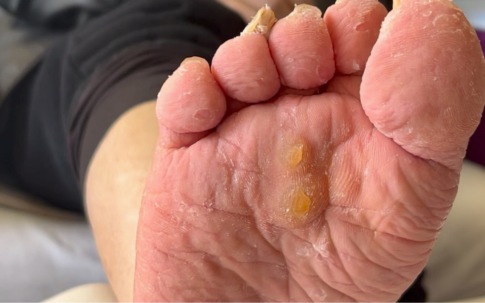 大鸡眼很深的根,轻轻一碰就疼