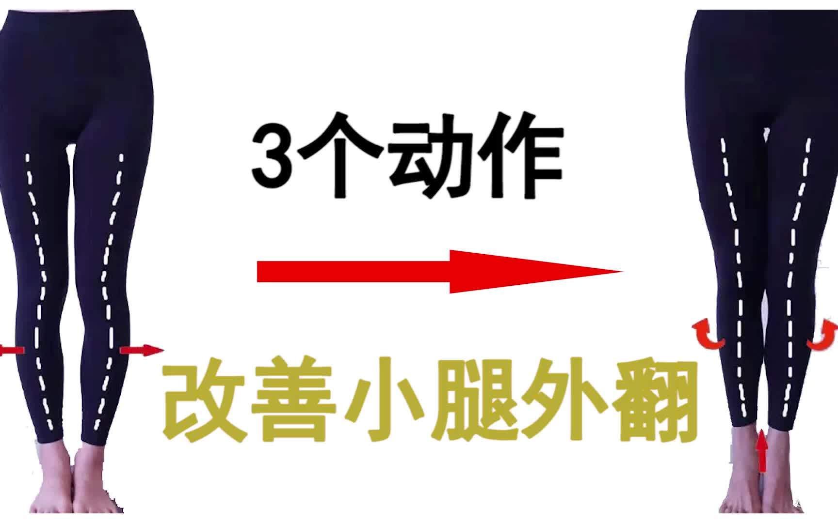 常见的小腿外翻该如何矫正?一招帮你轻松改善哔哩哔哩bilibili