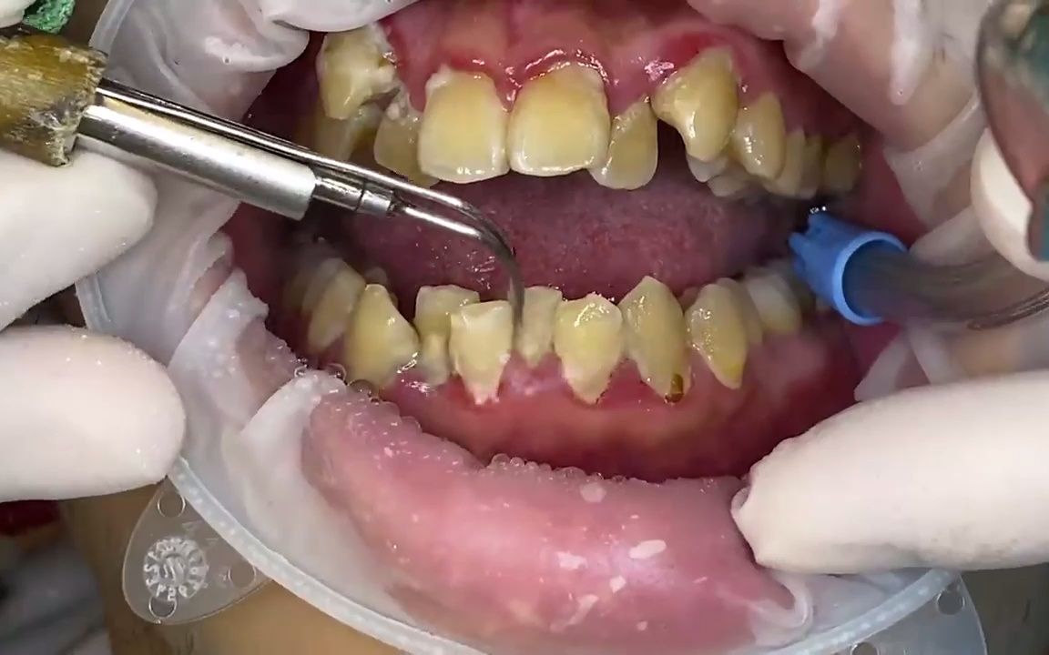 全口超厚重牙结石洗牙,预防牙周炎,口臭和各种口腔问题.