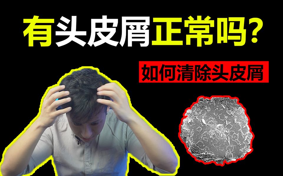 【医学博士】你会有头皮屑困扰问题吗?健康人会有头皮屑吗?哔哩哔哩bilibili