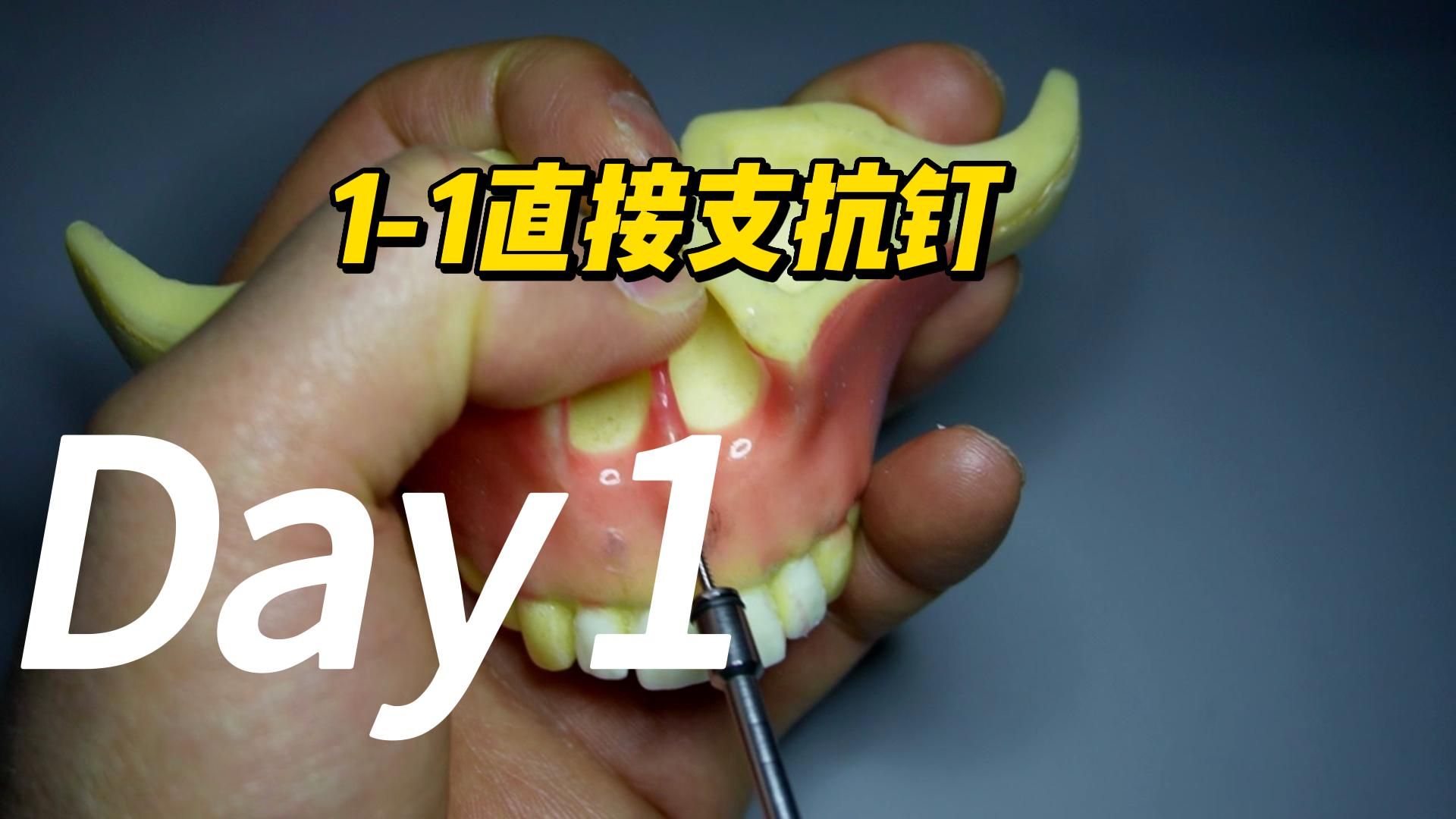 1-1之间支抗钉(节选)