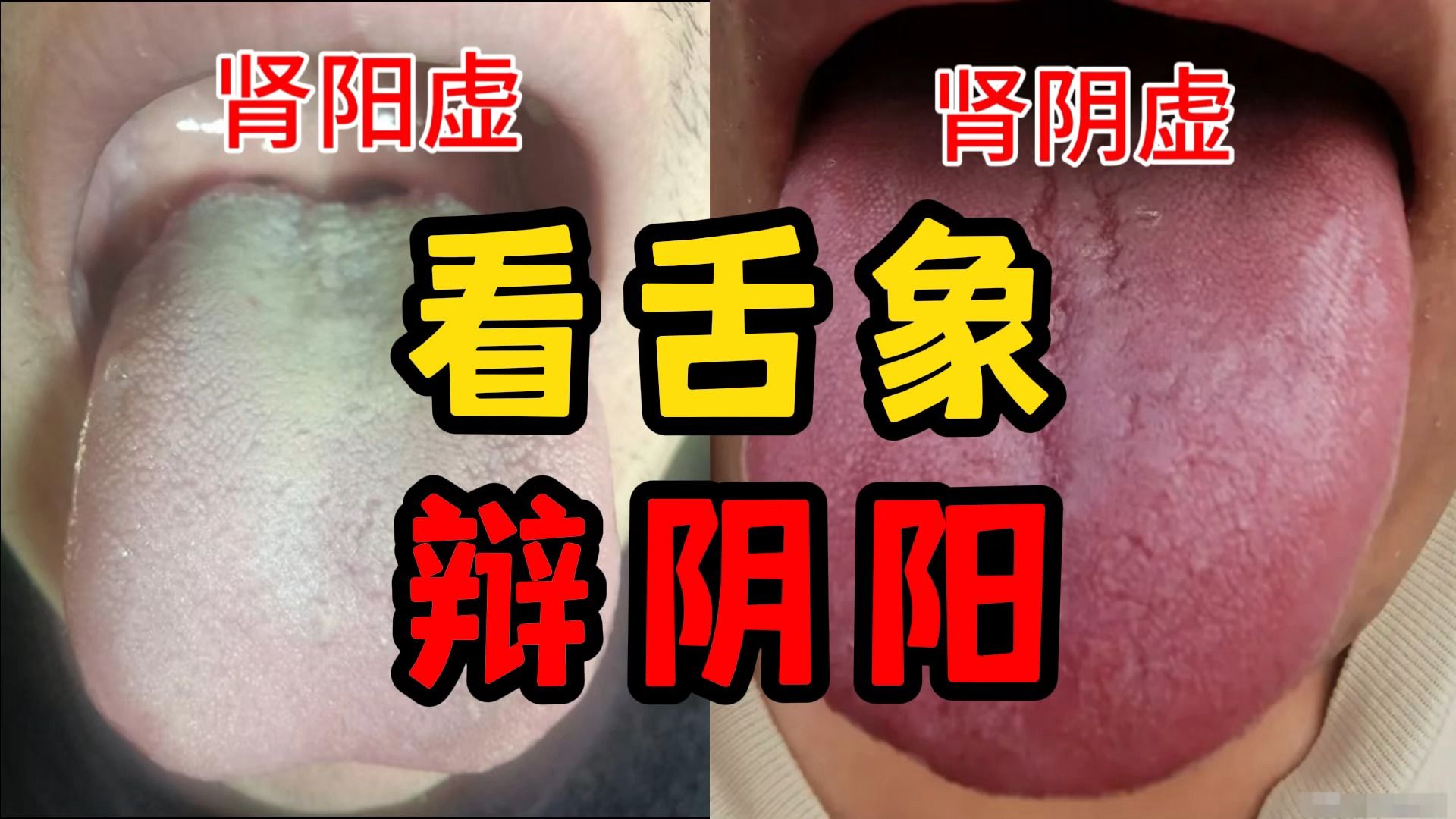 [图]【舌诊案例】中医教你看舌象，辨阴阳，以后肾阳虚、肾阴虚，再也不用傻傻分不清了！