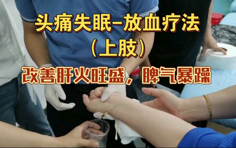 头痛失眠-放血疗法(上肢)改善肝火旺盛,脾气暴躁-伍玉文