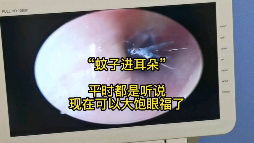 蚊子进耳朵真实视频