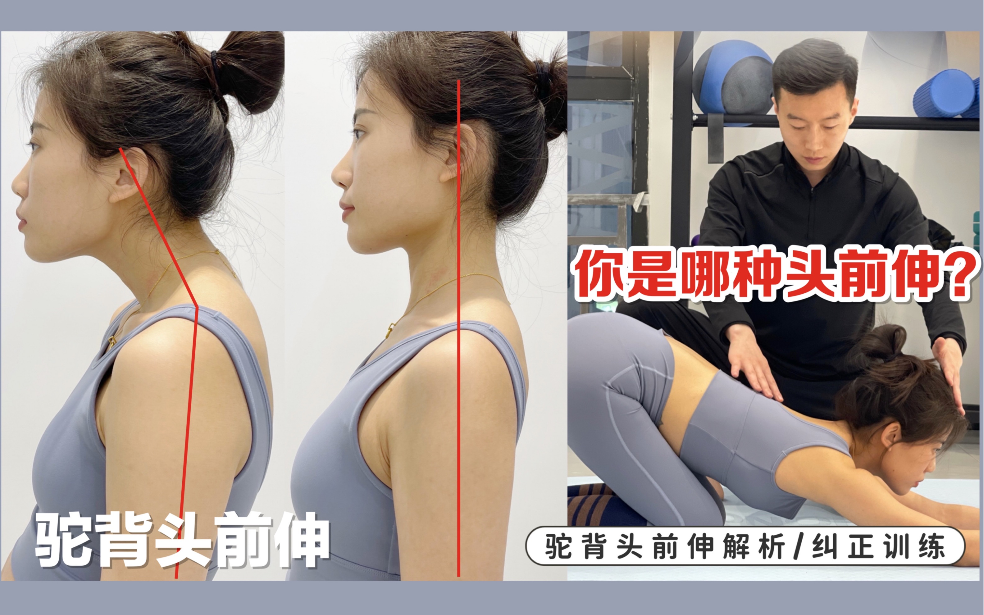 你是哪种头前伸?驼背头前伸纠正训练