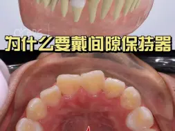 Download Video: 乳牙过早缺失，为什么要戴间隙保持器？