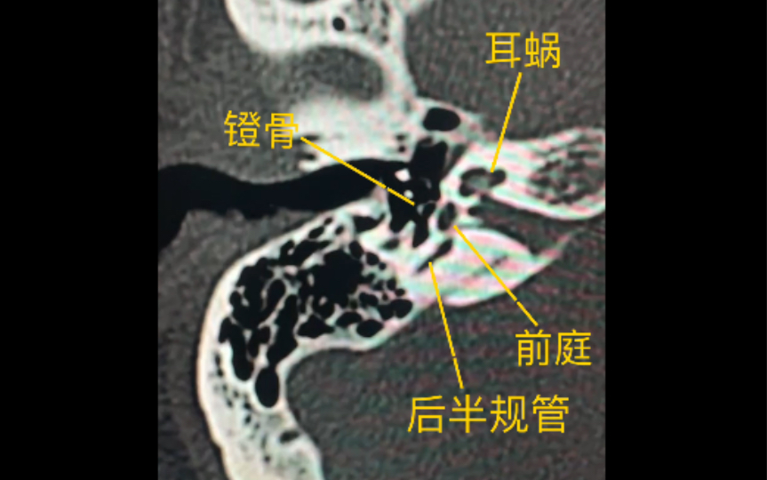 耳部ct解剖图片图片