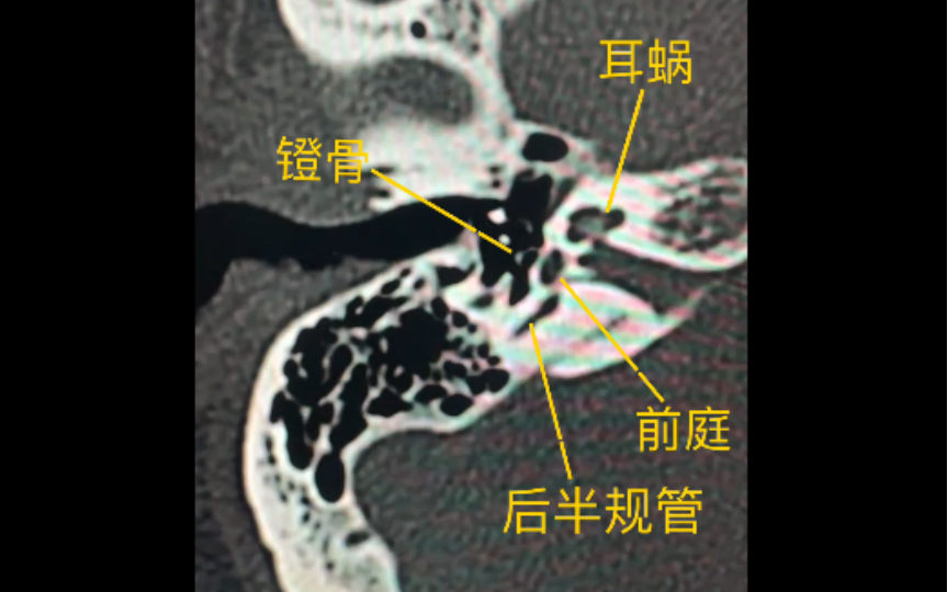 新手看耳部ct片图解图片