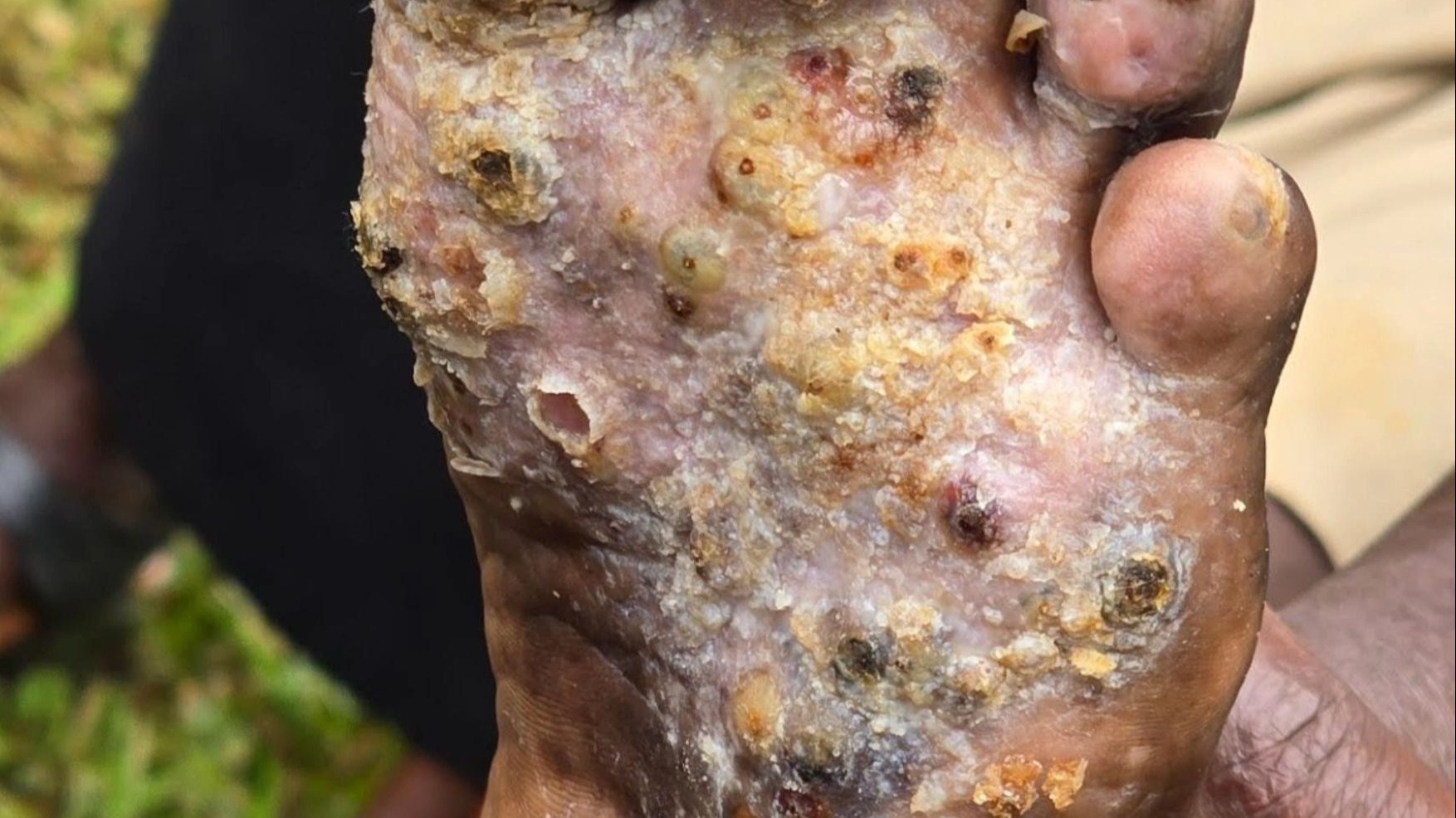 开饭了,开饭了,给黑子哥清理脚上寄生虫沙蚤