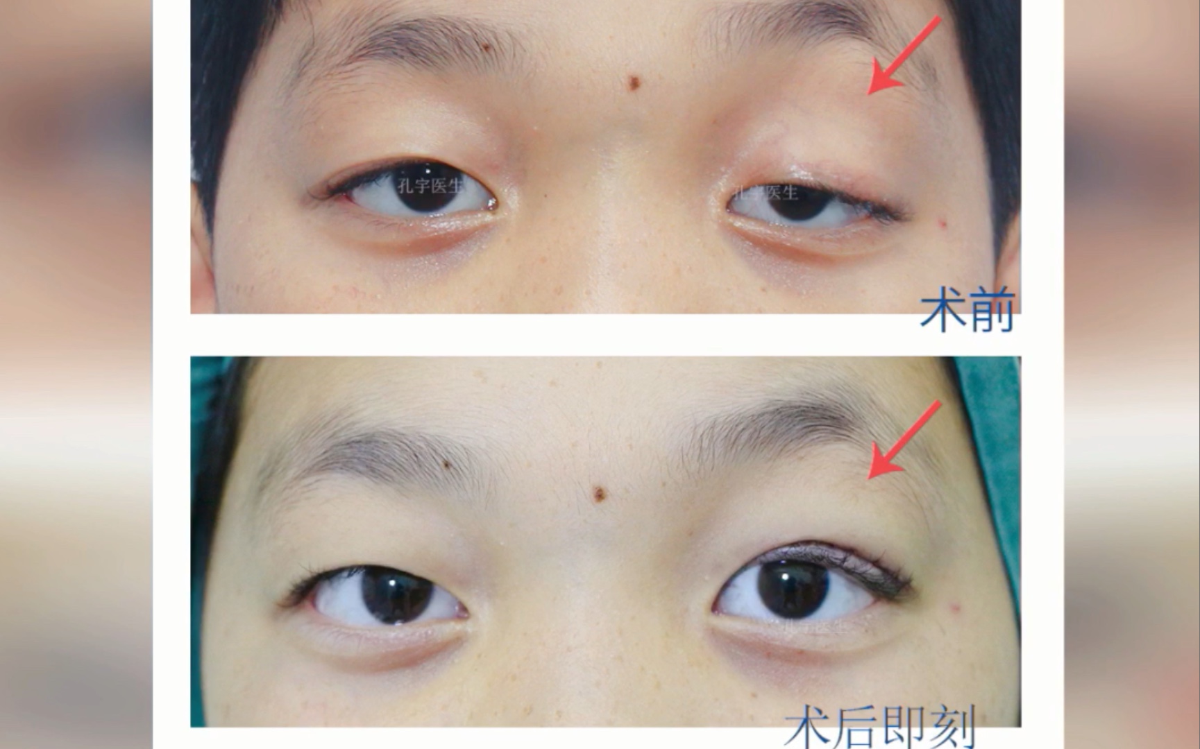 单侧重度眼睑下垂矫正分享11岁小伙子左眼先天性上睑下垂矫正后双眼