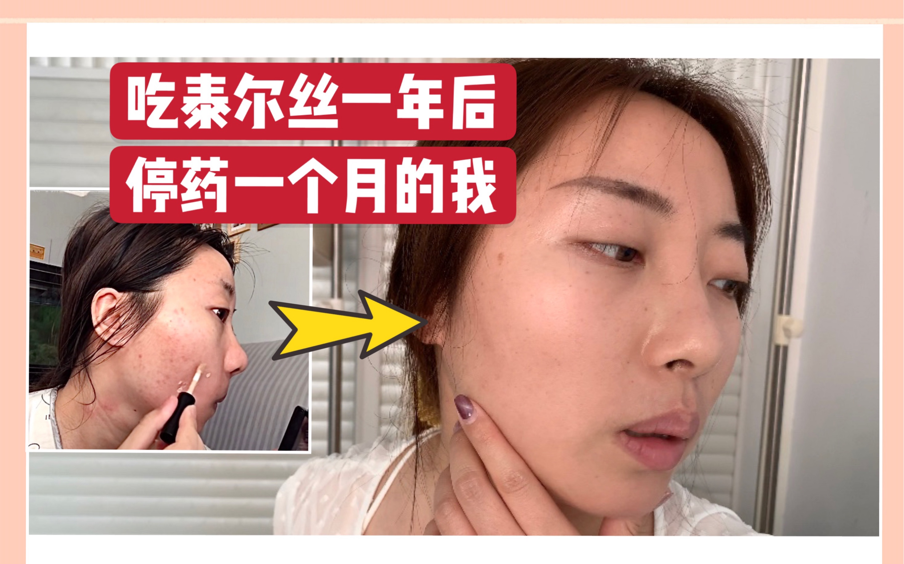 清子泰尔丝吃了一年停药后会不会复发