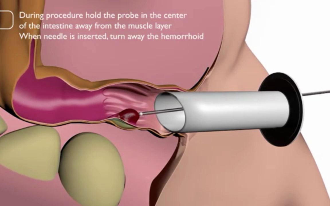 [图]3D视频：痔疮手术，坐立不安，带入感太强了！