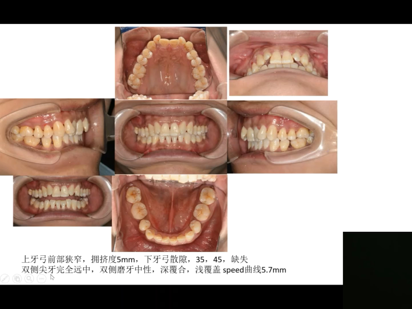 跟着病例学正畸1——赵高峰哔哩哔哩bilibili