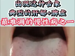 Video herunterladen: 出现这种舌象，典型的肝郁+脾虚，最难调的慢性病之一！