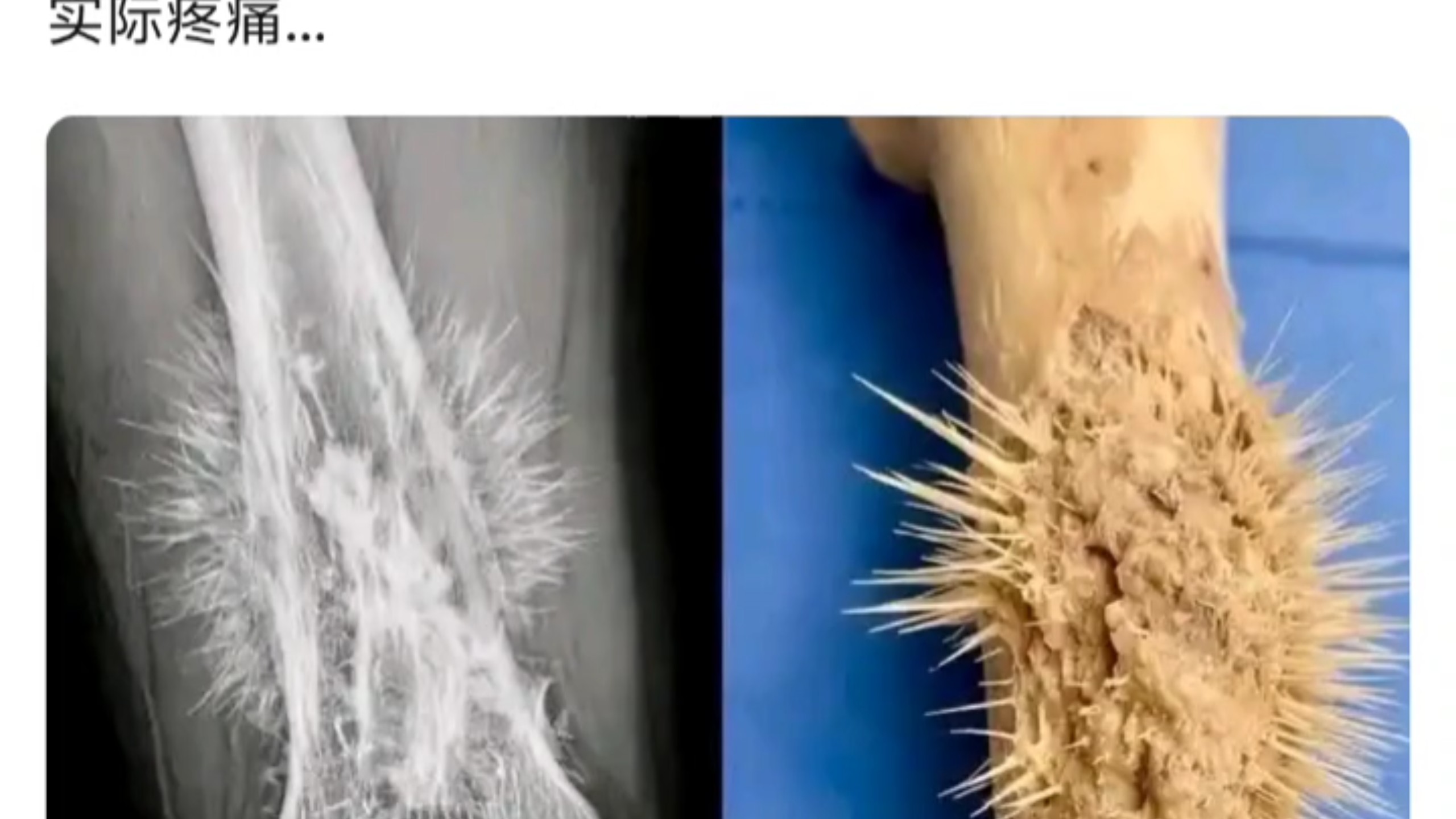 钻心的疼，骨癌患者的骨头