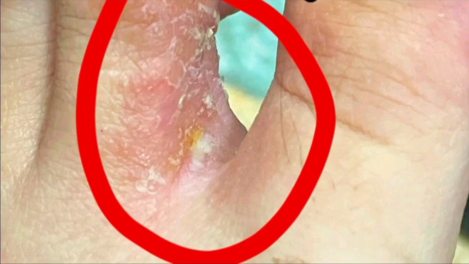 分享一下我自己得了脚气后是怎么治好的!