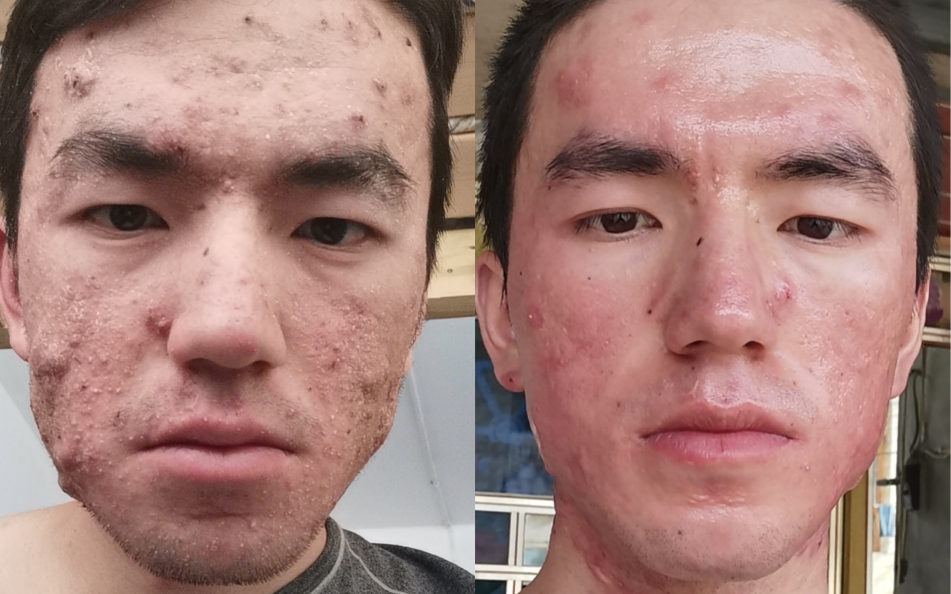 【花费10万元重度痤疮】1个月的变化