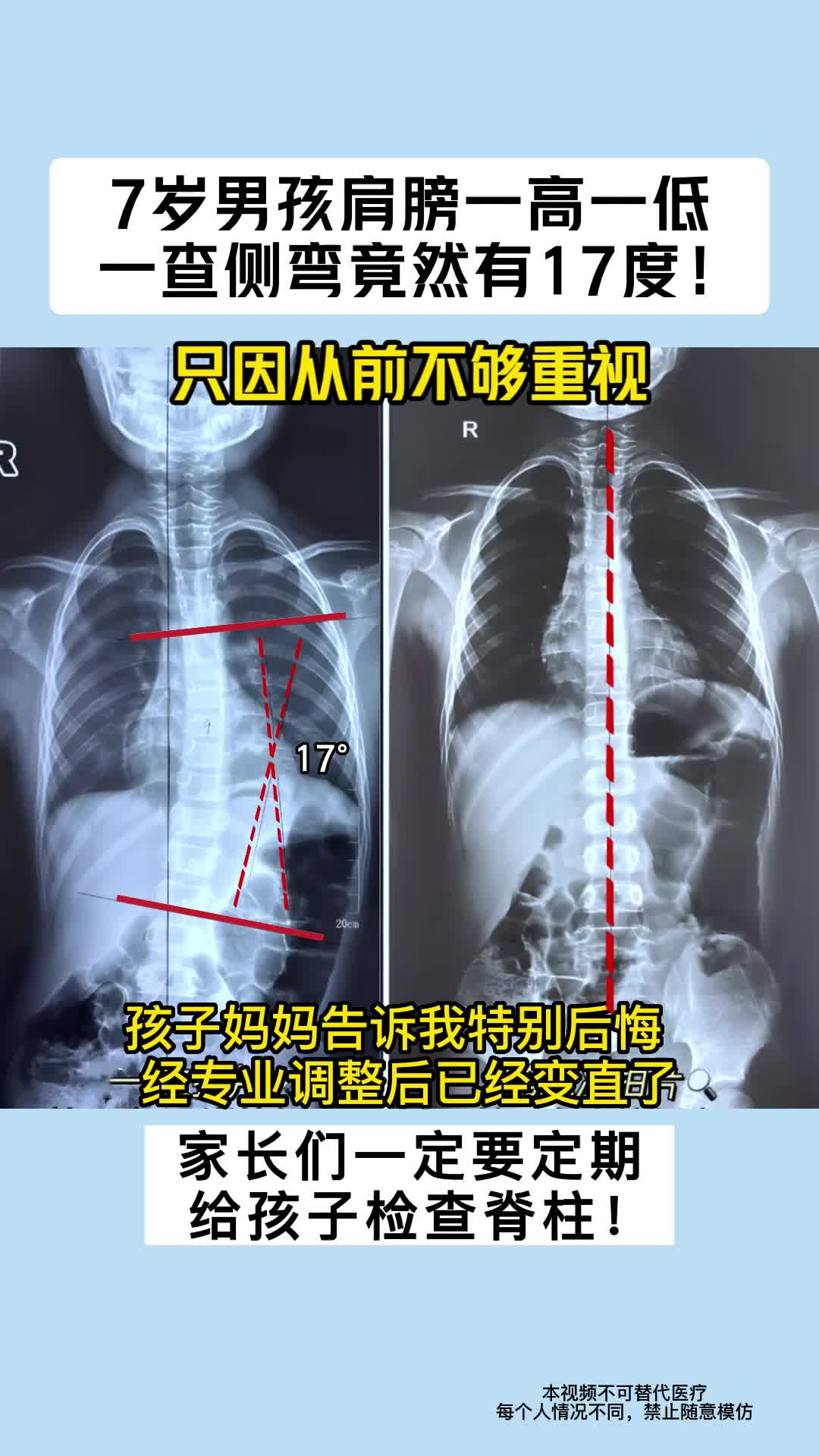 孩子肩膀一高一低,各位家长一定要注意定时给孩子检查脊柱