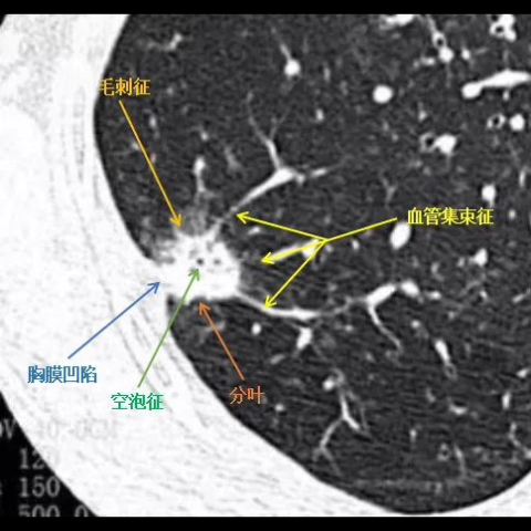 胸部CT:肺癌征象:血管集束征、毛刺征、胸膜凹陷征、空泡征、分叶哔哩哔哩bilibili