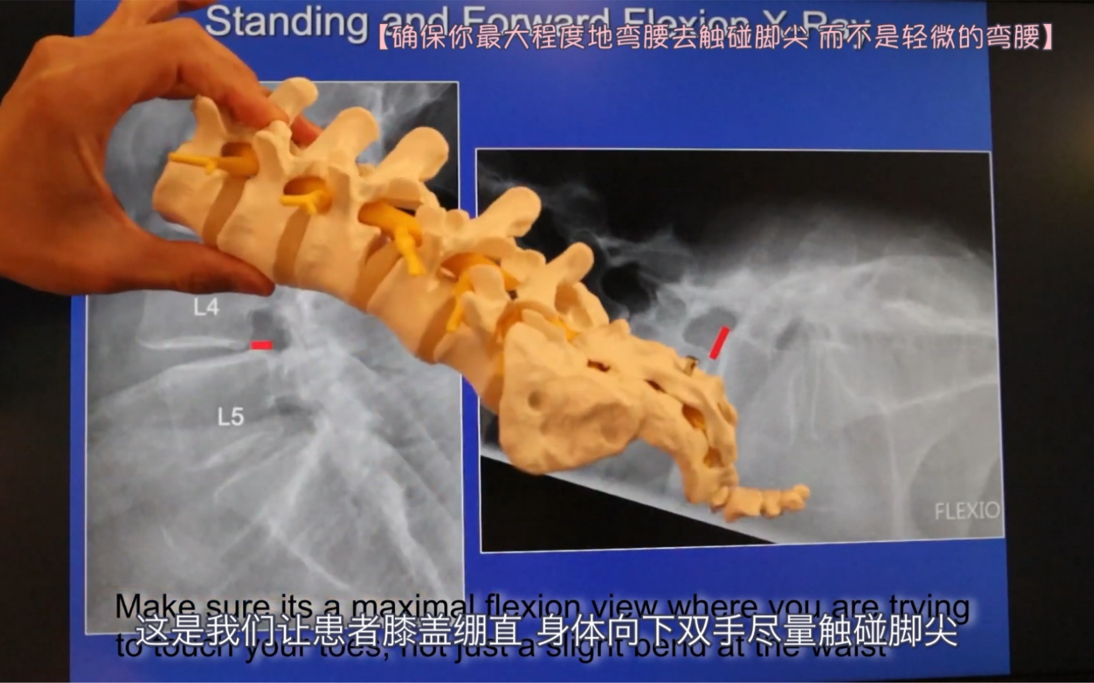 (中文字幕)The Spine Guy—什么是退行性腰椎滑脱哔哩哔哩bilibili