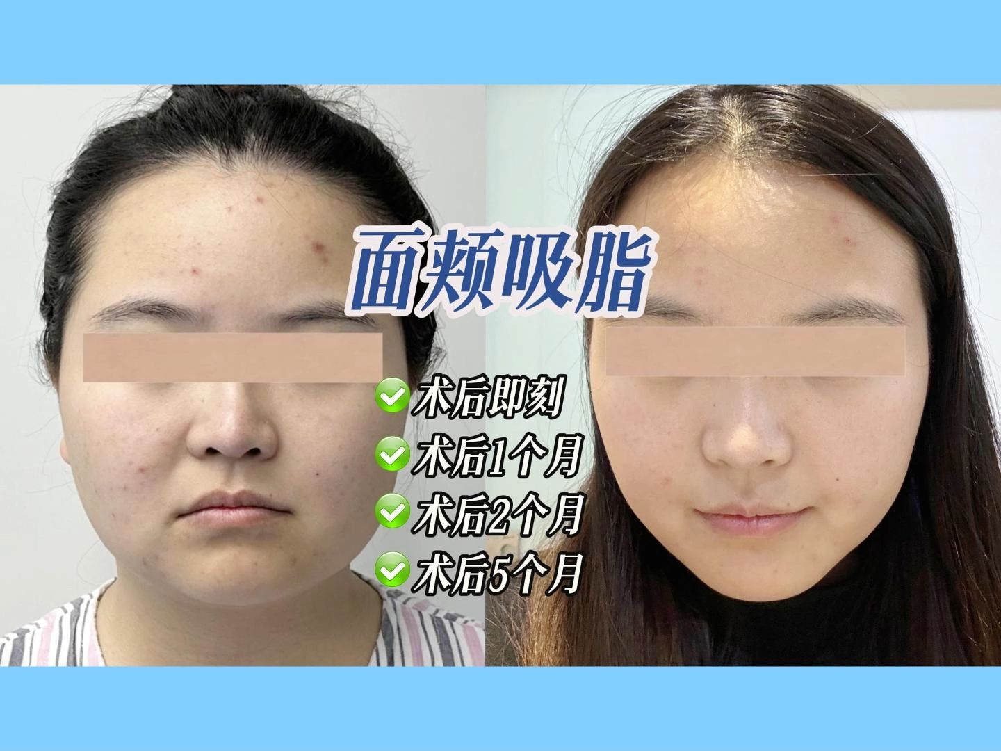 【案例】面部吸脂不同时期对比(5个月)