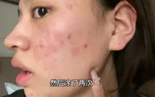 好多人推荐的异维A乳酸膏使用后严重烂脸 五一出来玩根本画不了装 整个脸都火辣辣的